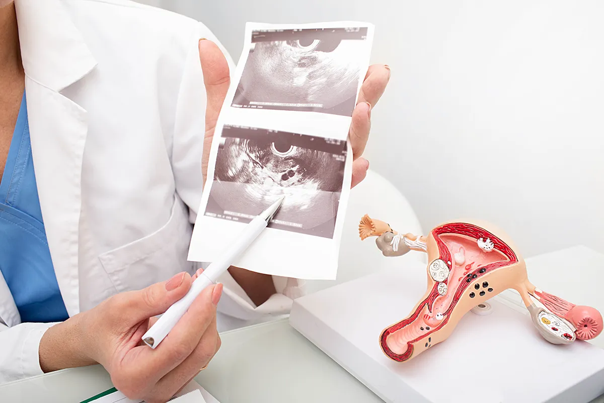Sonografía Transvaginal